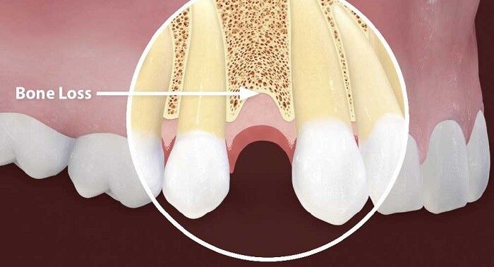 Bone loss what causes low jawbone density