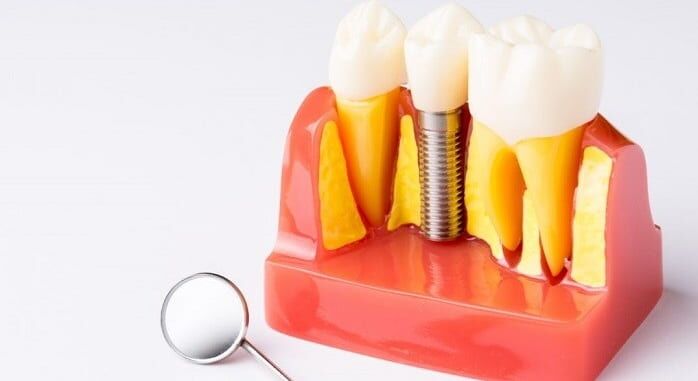 Managing dental implant failing