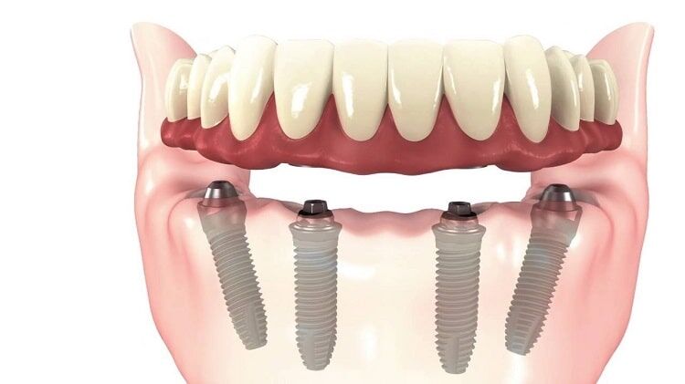 all on 4 dental implants : Benefits, procedure, side effects and recovery