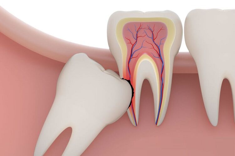 Impacted wisdom tooth