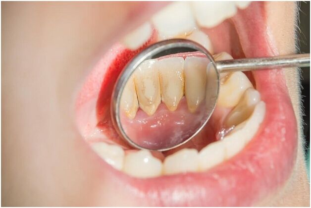 How to remove dental tartar at home