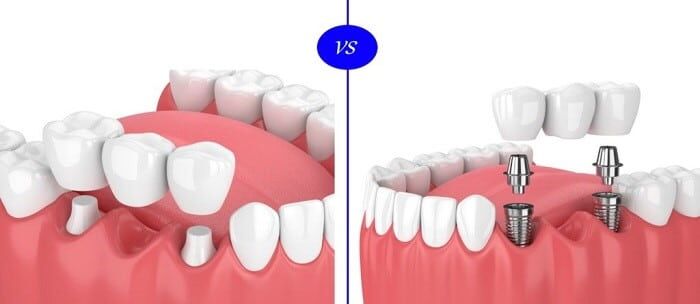 Dental implant vs bridge