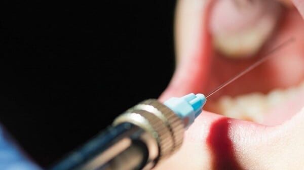 What types of anesthesia is used for dental work