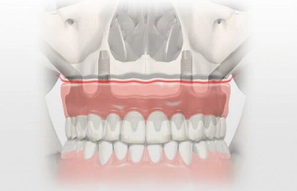 Zygomatic Implants