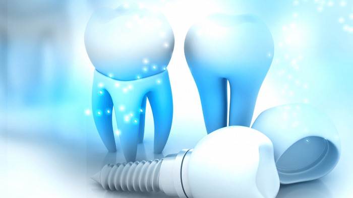 Non-metal dental implants in Laguna Niguel