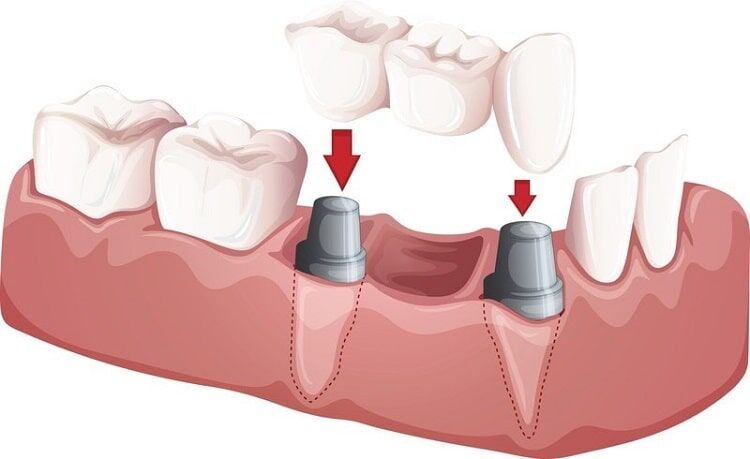 dental bridge