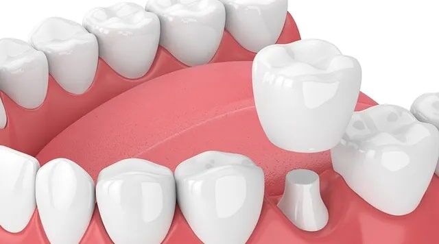 dental crown replacement