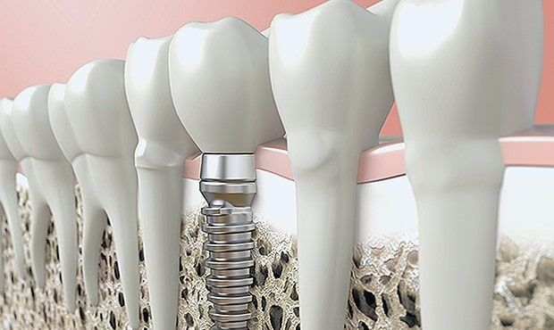 dental implant parts