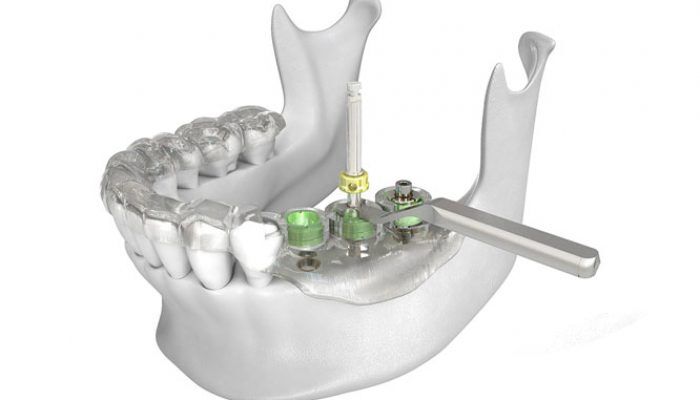 What is a digital dental implant